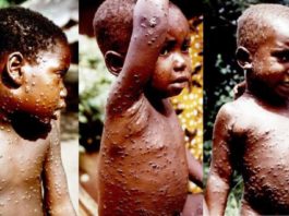 Monkey Pox