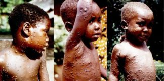 Monkey Pox