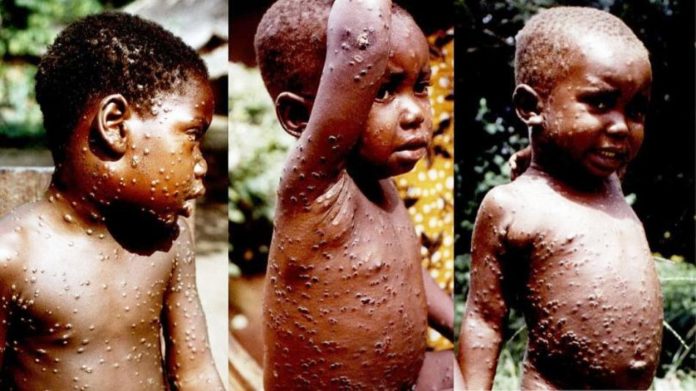 Monkey Pox