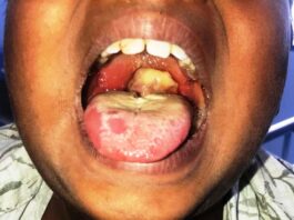 FMOH Partners MDAs to curb ongoing Diphtheria outbreak