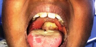 FMOH Partners MDAs to curb ongoing Diphtheria outbreak