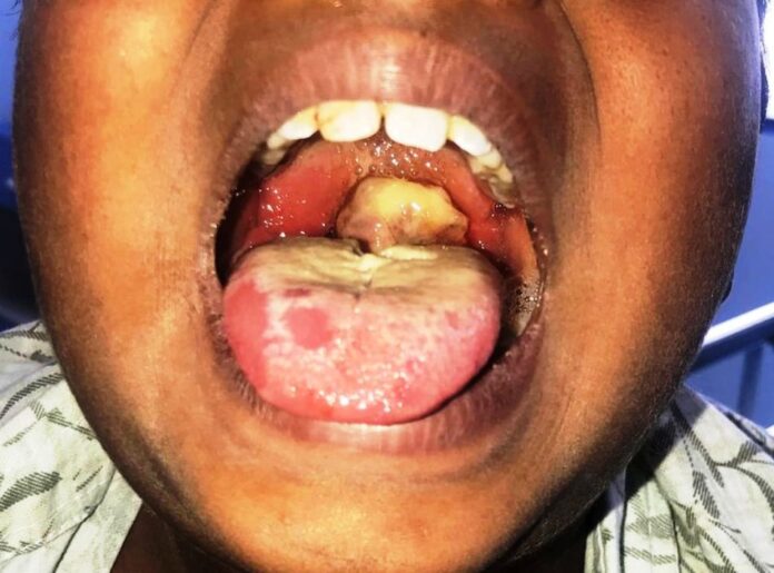 FMOH Partners MDAs to curb ongoing Diphtheria outbreak
